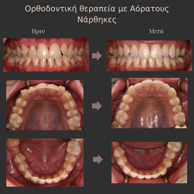Λεύκανση Δοντιών - 3