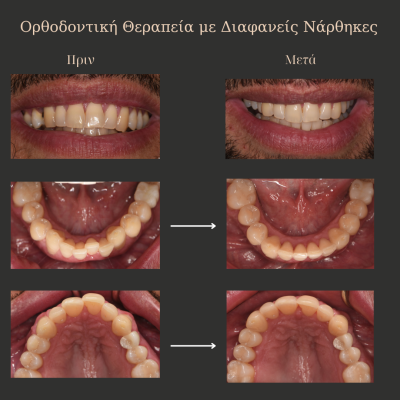 Παρατηρείτε αιμορραγία των ούλων κατά τη διάρκεια του βουρτσίσματος? - 43