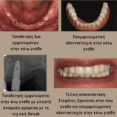ΕΠΕΝΘΕΤΗ-ΚΑΤΩ-ΕΠΙΕΜΦΥΤΕΥΜΑΤΙΚΗ-ΚΑΙ-ΖΙΡΚΟΝΙΑ-ΑΝΩ-1