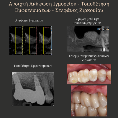 ανοιχτη ανυψωση ιγμορειου και τοποθετηση εμφυτευματων με στεφανες ζιρκονιου