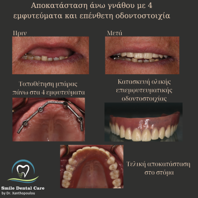 4 εμφυτευματα στην ανω γναθο με επενθετη οδοντοστοιχια