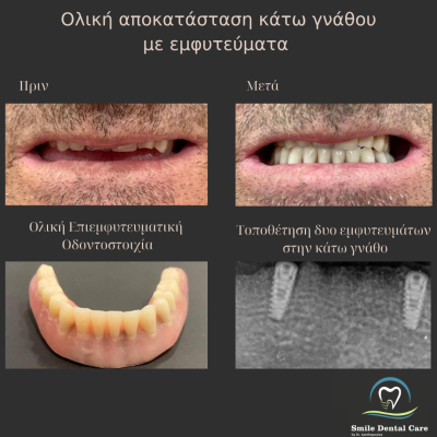 τοποθέτηση δυο εμφυτευμάτων στην κάτω γνάθο με επενθετη οδοντοστοιχια