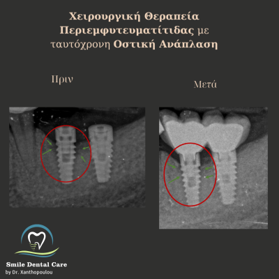 χειρουργικη θεραπεια περιεμφυτευματιτιδας