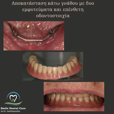 τοποθέτηση δυο εμφυτευμάτων στην κάτω γνάθο με επενθετη οδοντοστοιχια