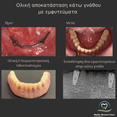 Λεύκανση Δοντιών - 1