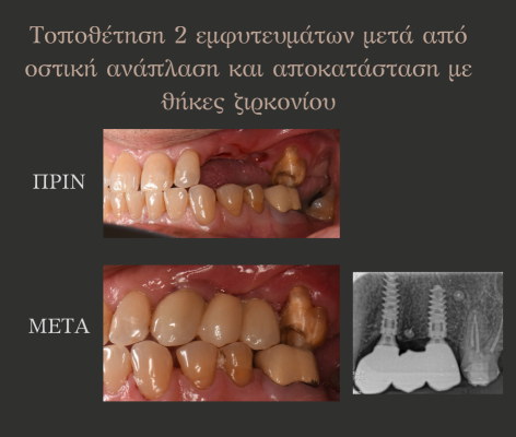 2_εμφυτευματα