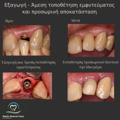 Λεύκανση Δοντιών - 1