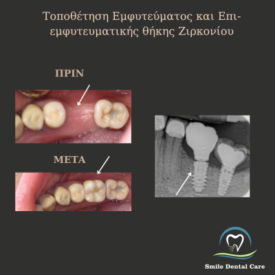 Παρατηρείτε αιμορραγία των ούλων κατά τη διάρκεια του βουρτσίσματος? - 6