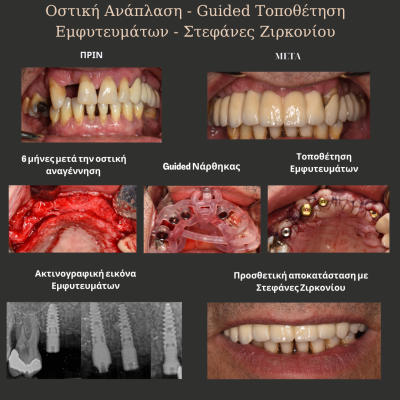 Παρατηρείτε αιμορραγία των ούλων κατά τη διάρκεια του βουρτσίσματος? - 14