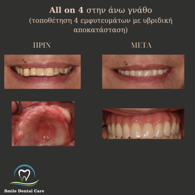 Παρατηρείτε αιμορραγία των ούλων κατά τη διάρκεια του βουρτσίσματος? - 9