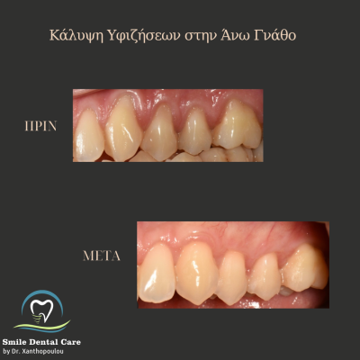 καλυψη υφιζησεων με μοσχευμα συνδετικου ιστου
