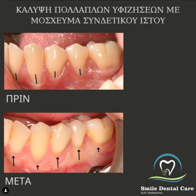 καλυψη υφιζησεων με μοσχευμα συνδετικου ιστου