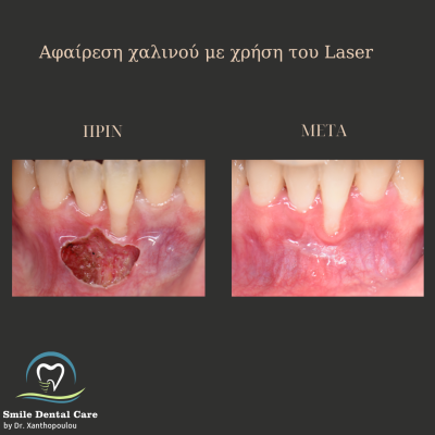 χαλινεκτομη με laser