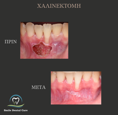 ΧΧΑΛΙΝΕΚΤΟΜΗ
