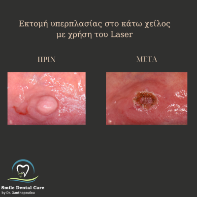 αφαιρεση επουλιδας με laser