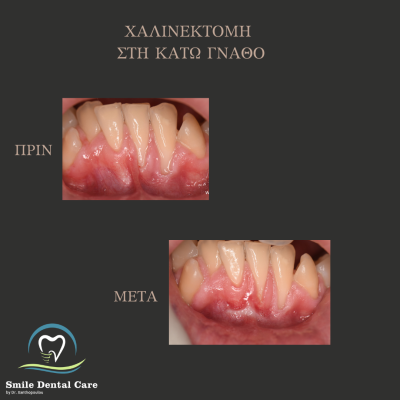 χαλινεκτομη με laser