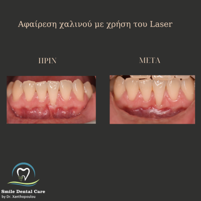 χαλινεκτομη με laser