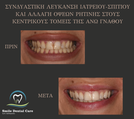 ΛΕΥΚΑΝΣΗ-ΚΑΙ-ΟΨΕΙΣ