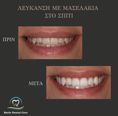 λευκανση δοντιων με μασελακια
