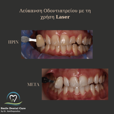 λευκανση δοντιων στο ιατρειο με laser