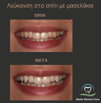 λευκανση-ιατρειου