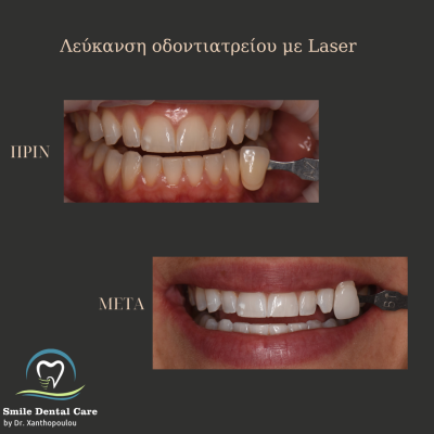 λευκανση δοντιων στο ιατρειο με laser