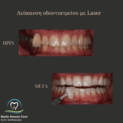 λευκανση δοντιων στο ιατρειο με laser