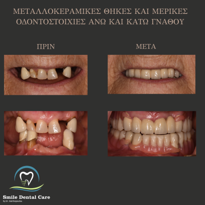 μερικη οδοντοστοιχια ανω και κατω γναθου