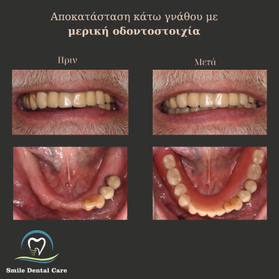 μερικη οδοντοστοιχια κατω γναθου