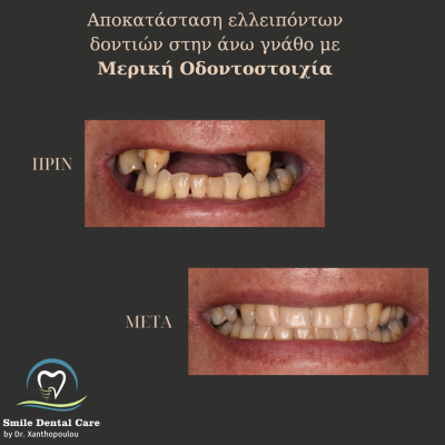 μερικη οδοντοστοιχια ανω γναθου