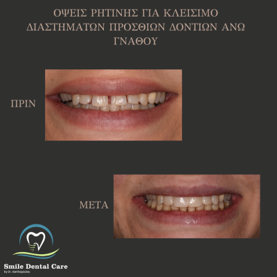 οψεις ρητινης για κλεισιμο διαστηματων ανω γναθου