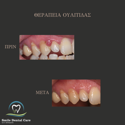 ΠΡΙΝ - 1