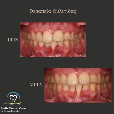 θεραπεια ουλιτιδας