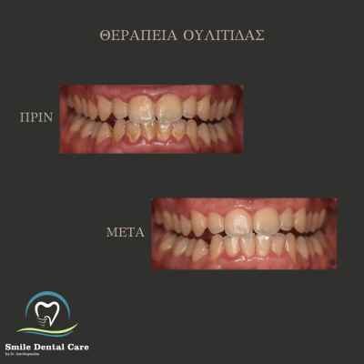 ΠΡΙΝ - 2