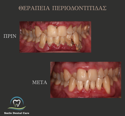 ΘΕΡΑΠΕΙΑ-ΠΕΡΙΟΔΟΝΤΙΤΙΔΑΣ