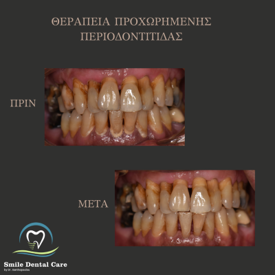 ΘΕΡΑΠΕΙΑ ΠΕΡΙΟΔΟΝΤΙΤΙΔΑΣ
