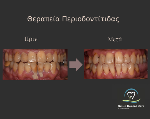 θεραπεια-περιοδοντιτιδας