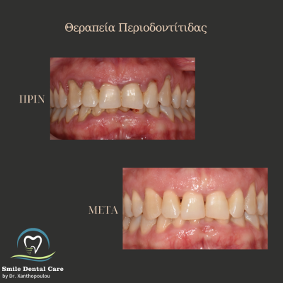 ΘΕΡΑΠΕΙΑ ΠΕΡΙΟΔΟΝΤΙΤΙΔΑΣ