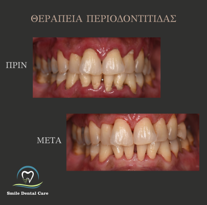 1_ΘΕΡΑΠΕΙΑ-ΠΕΡΙΟΔΟΝΤΙΤΙΔΑΣ