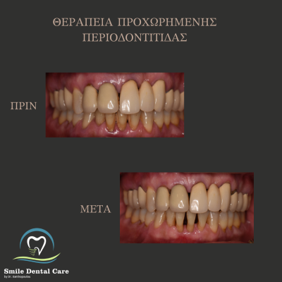 ΘΕΡΑΠΕΙΑ ΠΕΡΙΟΔΟΝΤΙΤΙΔΑΣ