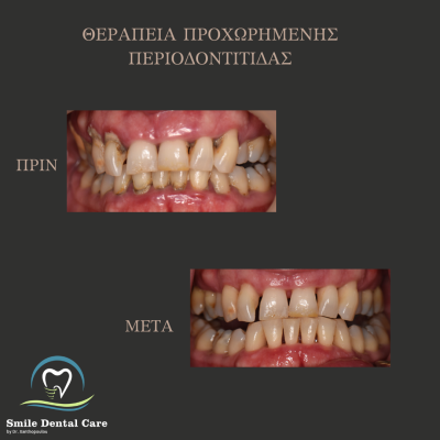 ΘΕΡΑΠΕΙΑ ΠΕΡΙΟΔΟΝΤΙΤΙΔΑΣ
