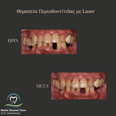 Παρατηρείτε αιμορραγία των ούλων κατά τη διάρκεια του βουρτσίσματος? - 25