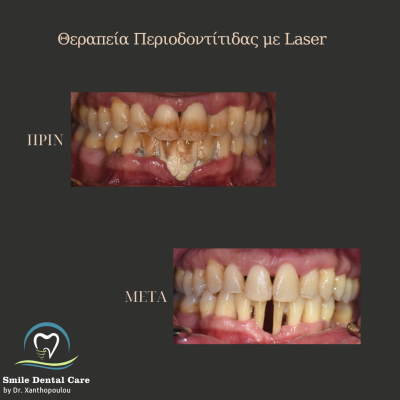 Παρατηρείτε αιμορραγία των ούλων κατά τη διάρκεια του βουρτσίσματος? - 25