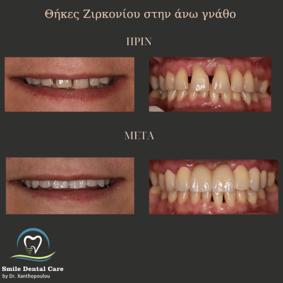 στεφανες ζιρκονιου ανω  γναθου