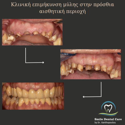 κλινικες επιμηκυνσεις και στεφανες πορσελανης