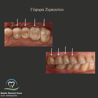 Παρατηρείτε αιμορραγία των ούλων κατά τη διάρκεια του βουρτσίσματος? - 26