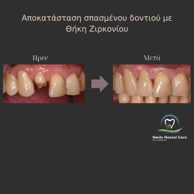 Λεύκανση Δοντιών - 2