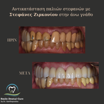 στεφανες ζιρκονιου ανω γναθου