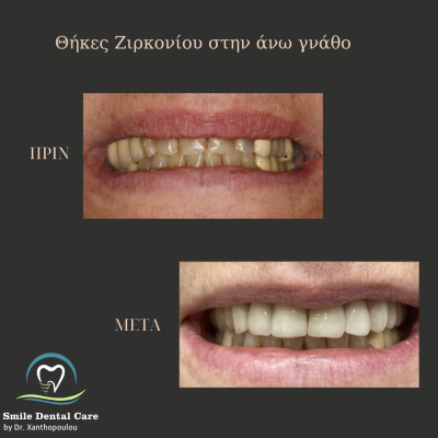 στεφανες ζιρκονιου ανω γναθου
