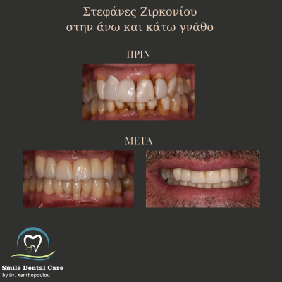 στεφανες ζιρκονιου ανω  και κατω γναθου